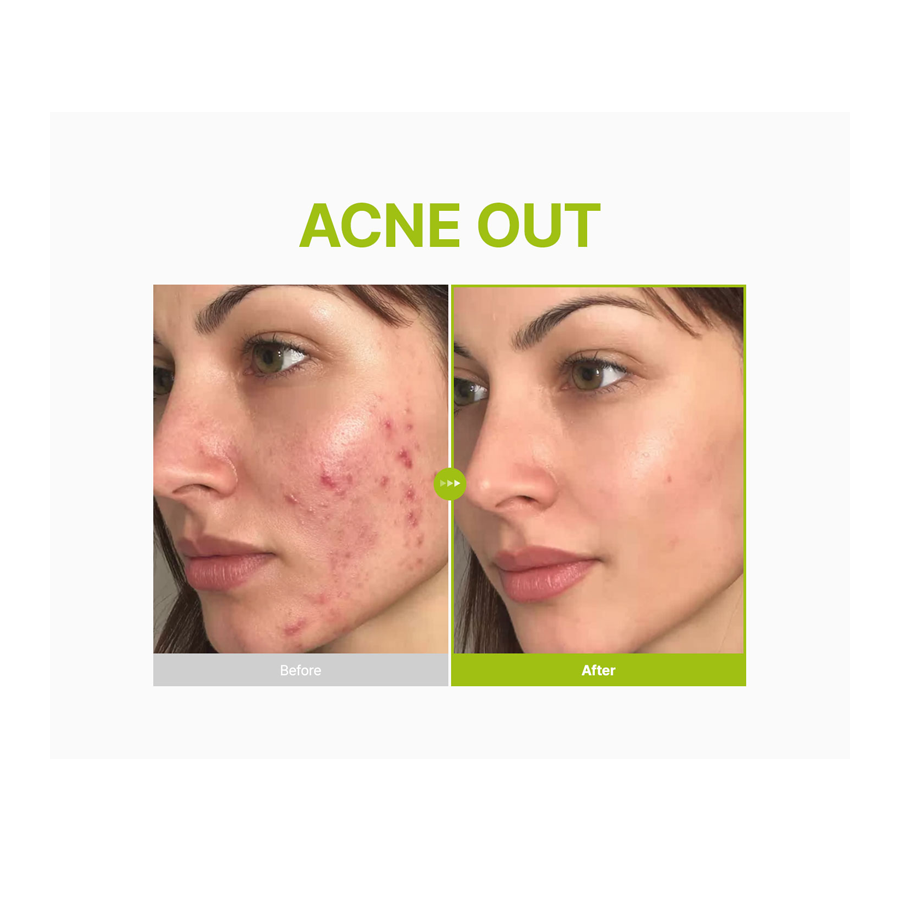 Azelaic Acid 10 Kojic Tea Tree Serum 30Ml